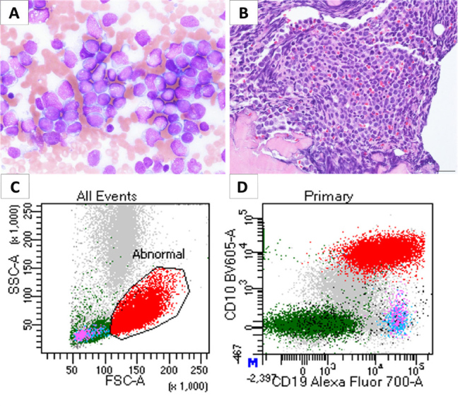 Lineage Switch of Adult B-Cell Acute Lymphoblastic Leukaemia to Acute Myeloid Leukaemia Following B-Cell-Directed Therapy.