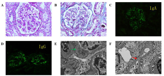 Pathogenic synonymous variation of the COL4A3 gene causing Alport syndrome comorbid with IgA deposition in a toddler: a case report.