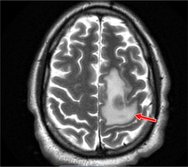 Diagnostic and Therapeutic Paradoxes in PCR-Positive, Histopathology-Negative CNS Aspergillosis in A Patient with HIV and Hodgkin Lymphoma.