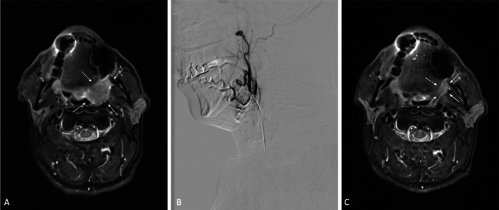 Efficacy and safety of transarterial chemoperfusion for head and neck malignancies.