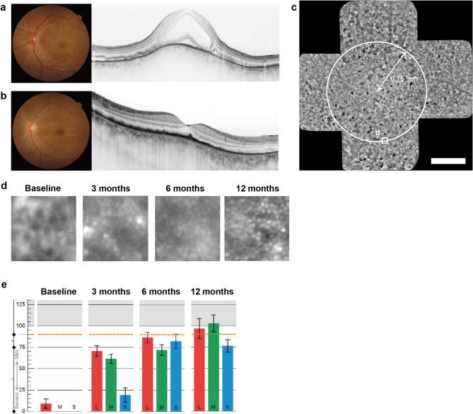 Dynamics of color vision recovery in Vogt-Koyanagi-Harada disease: a longitudinal study using cone contrast test and adaptive optics imaging.