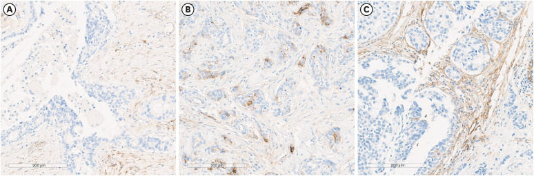 CD39 and CD73 Expression in Breast Cancer: CD73 as a Favorable Prognostic Factor in HER2-Positive Tumors.
