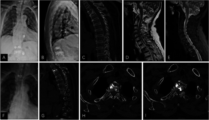 TiRobot-assisted percutaneous vertebroplasty in the management of middle and upper thoracic osteoporotic vertebral compression fracture.