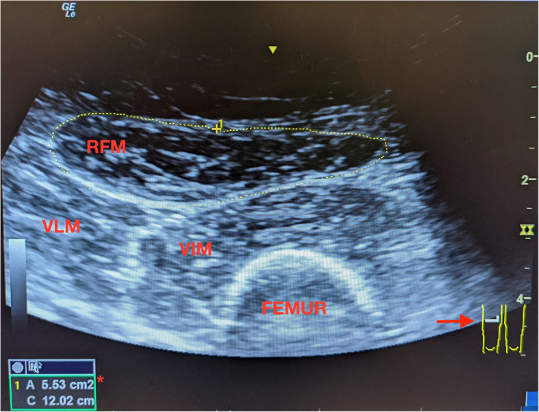 Ultrasound-based assessment of muscle mass is associated with early recovery after kidney transplant: a prospective single-center study.
