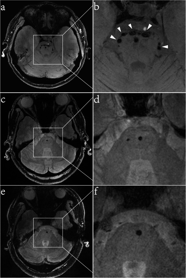 Diagnostic performance of "pons chocolate chip sign" in heterozygous HTRA1-related cerebral small vessel disease.