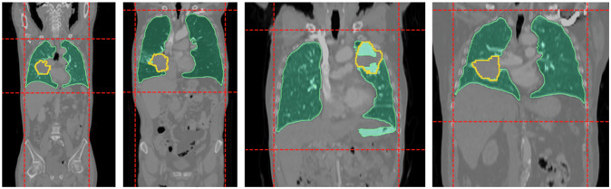 Advancing deep learning-based segmentation for multiple lung cancer lesions in real-world multicenter CT scans.