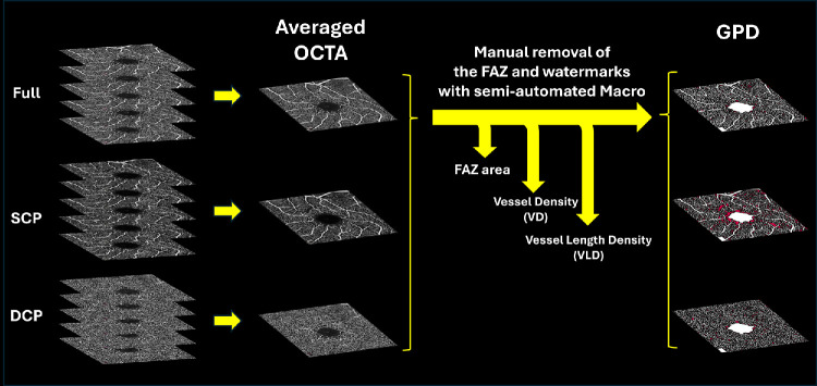 The Importance of Matching Optical Coherence Tomography Angiography Metrics to Diabetic Retinopathy Severity for Detecting Progression.