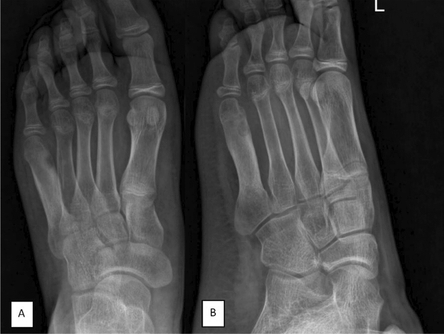 Presentation of osteoid osteoma in the fifth metatarsal: a case report and review of the literature.