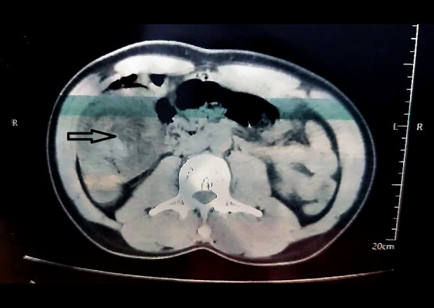 Uncommon Ileo-Cecal Intussusception in Adults: A Case Report of Diagnosis and Management.