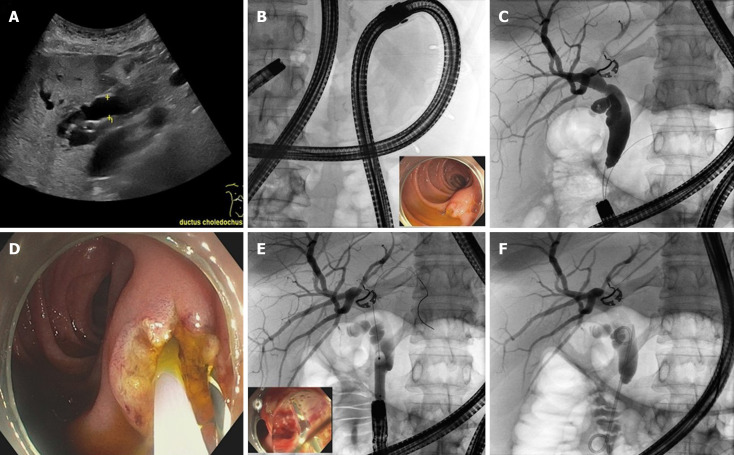 Motorized spiral enteroscopy assisted endoscopic retrograde cholangiography in patients with Roux-en-Y-anatomy.