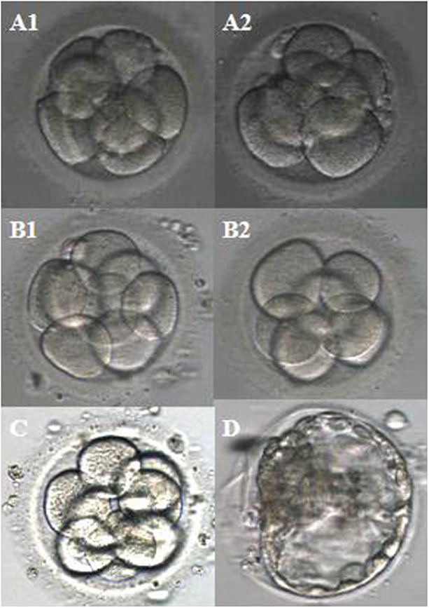 Successful live birth of a healthy infant by preimplantation genetic testing for aneuploidy in a couple with recurrent spontaneous abortion: a case report.