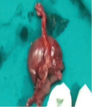 Labium Majus Ectopic Pregnancy: Diagnostic and Therapeutic Implications of a Rare Obstetric Phenomenon-A Case Report.