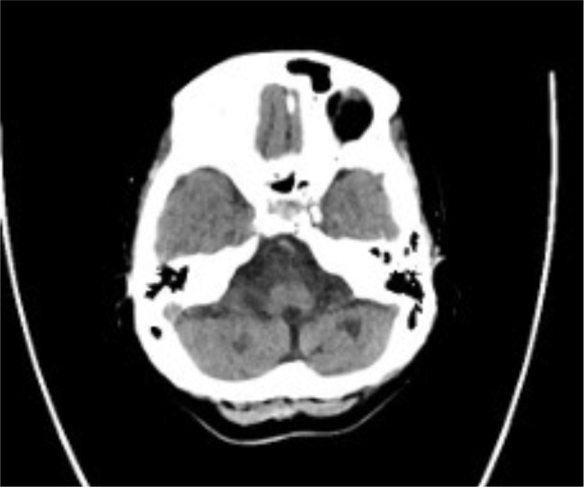 Rapidly Progressive Primary Central Nervous System Vasculitis: A Rare Case with Multifocal Small and Medium Vessel Involvement.