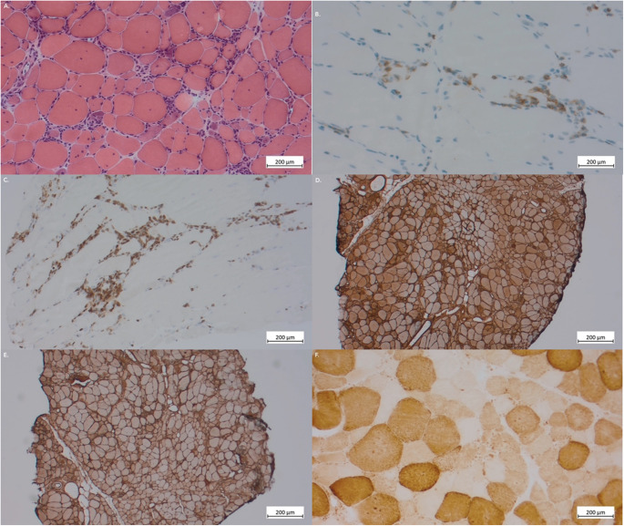 Antisynthetase Syndrome during anti-TNF-alpha Therapy: Report of Two Cases.