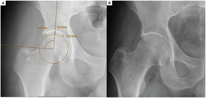 The Preoperative Central Joint Space Holds Greater Clinical Significance in Patients Aged 35 and Older Undergoing Primary Hip Arthroscopy.