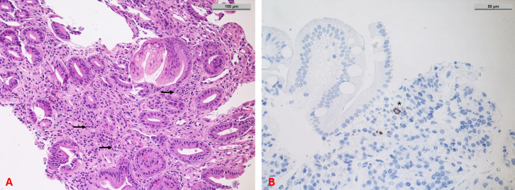 Haematemesis in an elderly patient.