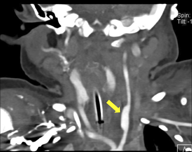 Management of a Pseudoaneurysm After Carotid-Esophageal Fistula Repair Secondary to Button Battery Ingestion in an Infant.