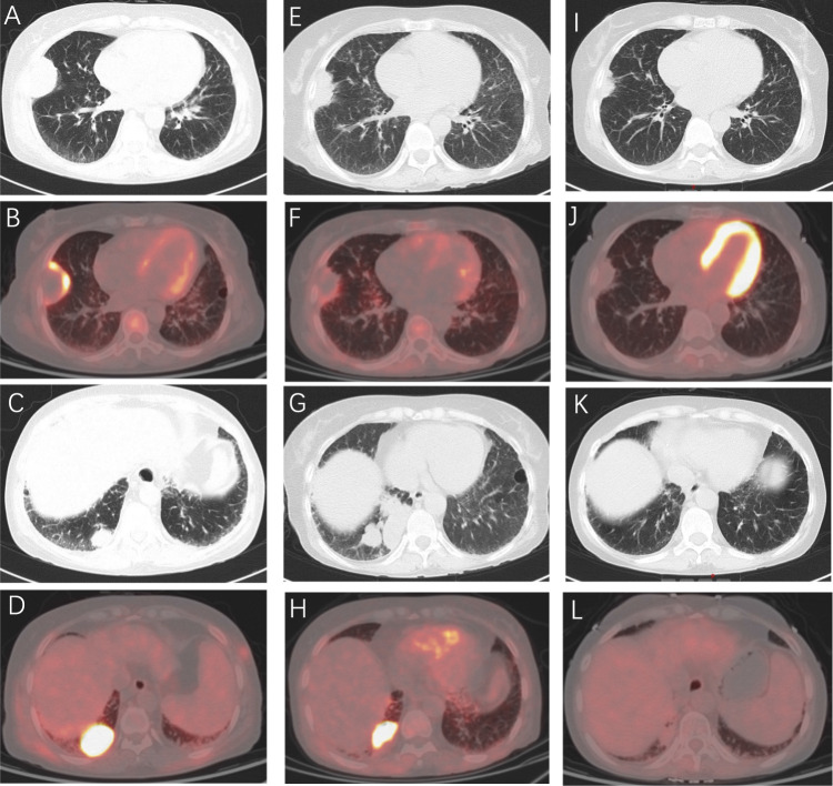 Successful Treatment of Diffuse Large B-Cell Lymphoma and Antisynthetase Syndrome with Bispecific Antibody Glofitamab.