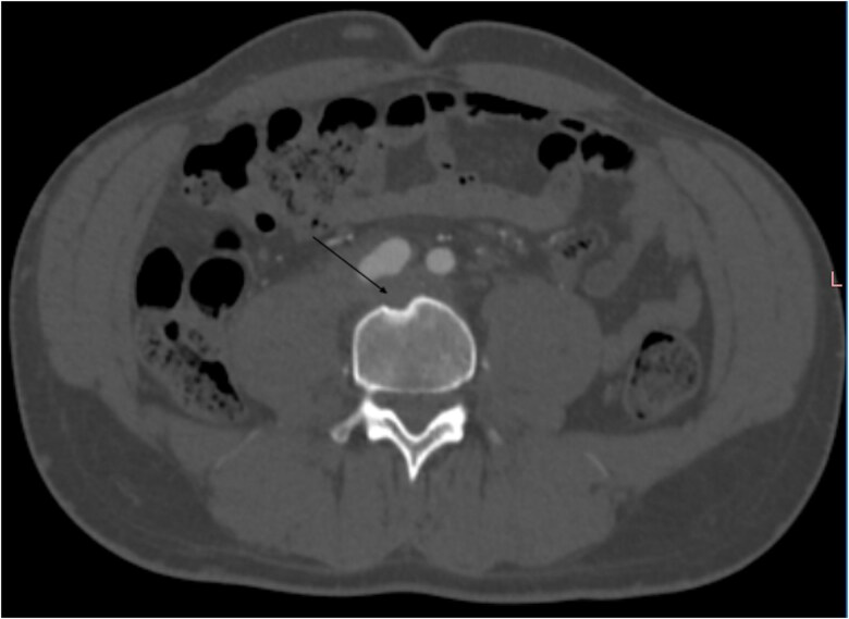 A rare etiology of right lower back pain in a young man: contained rupture of the common iliac artery aneurysm.