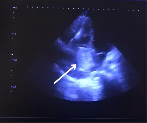 Giant right atrial myxoma emerging from the suprahepatic inferior vena cava, extending to the right atrium; a case report and literature review.