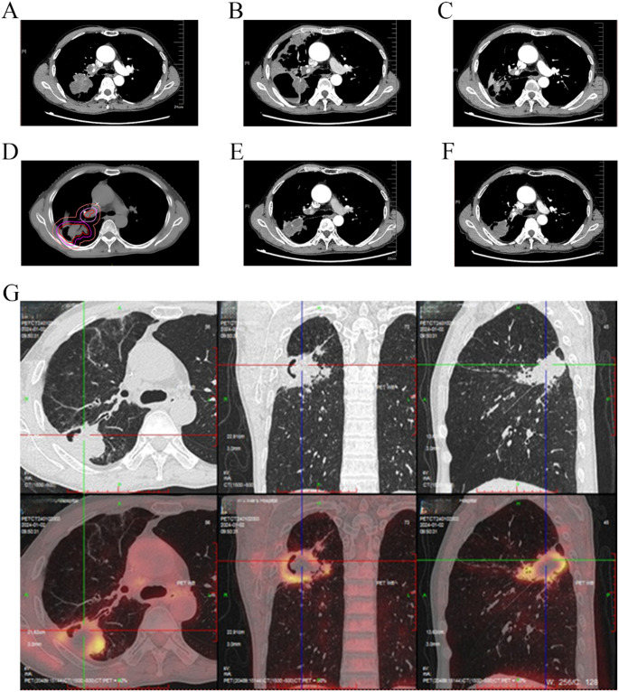 Long-term survival of a SMARCA4-deficient undifferentiated thoracic tumor with brain metastasis successfully treated with multimodal treatment: a case report and literature review.