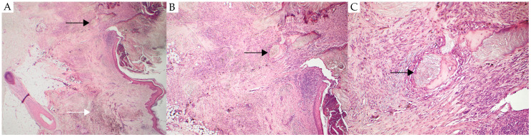 Osteonevus of Nanta-A Rare Case Report of a Cellular Blue Nevus with Ossification.