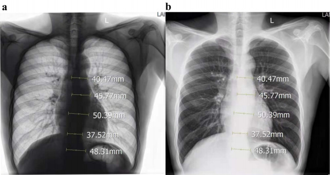 Delayed diagnosis of aortic dissection: the overlooked clues on chest X-ray.