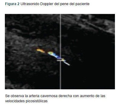 [High-flow priapism without a history of trauma: A case report].