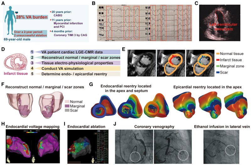 Case report of ventricular tachycardia simulation facilitated ablation for refractory ventricular arrhythmia post-myocardial infarction: aiming before firing.