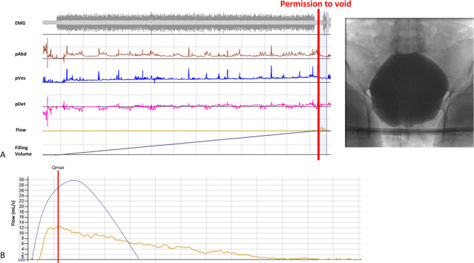 Conus medullaris and cauda equina syndrome as complications of non-imaging guided epidural steroid injection: two case reports with comprehensive interdisciplinary work-up.
