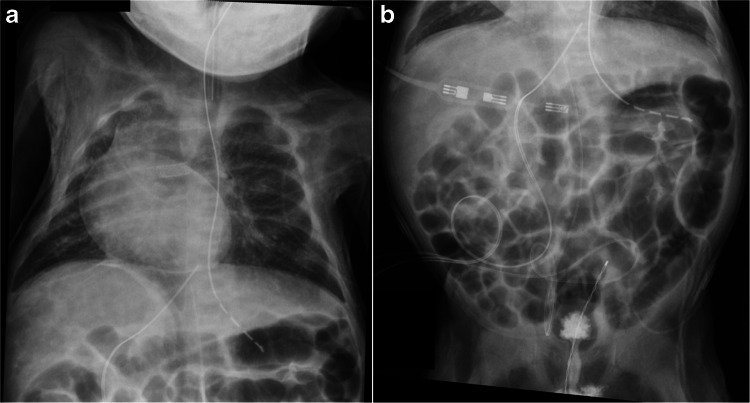 Incidence and factors associated with serosal and soft tissue enhancement after cardiac catheterization in infants.