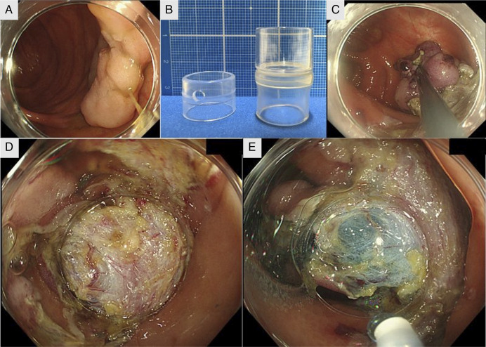 Usefulness of the Long Cap-Assisted Method for Securing Countertraction During Endoscopic Submucosal Dissection.