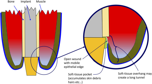 Use of a "Fascial-Sock" Technique to Manage the Stump and Stoma After Insertion of an Osseointegrated Implant in Transfemoral Amputees.