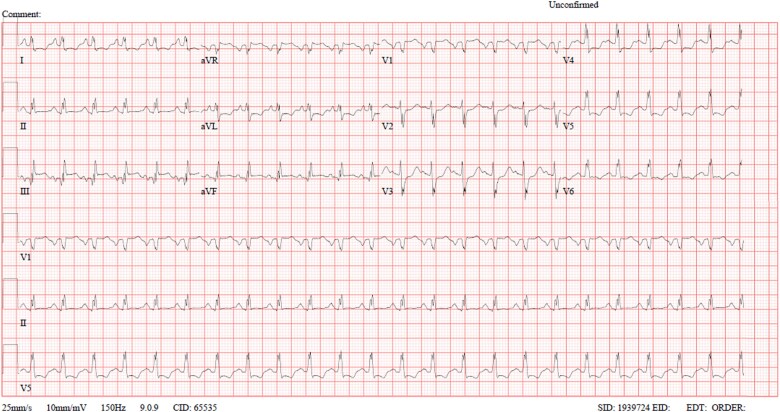 Severe cardiopulmonary complications of ketamine: Acute pulmonary Edema in a cardiac patient.