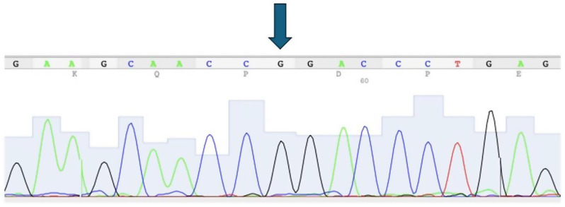 Exploring the presence of the GPR126 single nucleotide polymorphism (rs536714306) in periodontal patients of European ancestry.