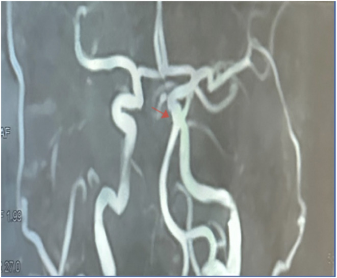 Multicentric comparative study of botulinum toxin treatment in patients with hemifacial spasm.