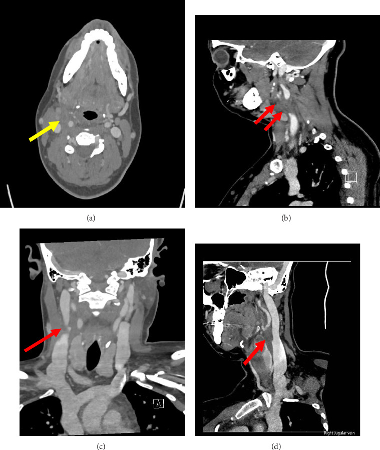 Isolated Facial Vein Thrombophlebitis Caused by <i>Fusobacterium nucleatum</i>: A Lemierre-Variant Case.
