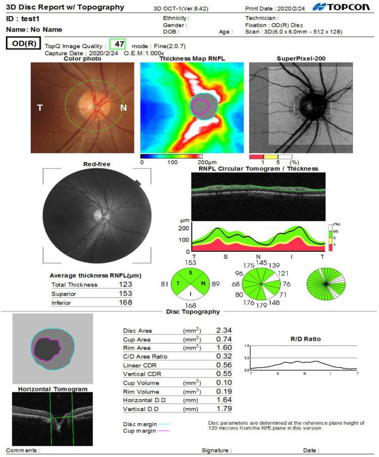 The Impact of Helicobacter pylori Infection on Retinal Nerve Fiber Layer and Macula.
