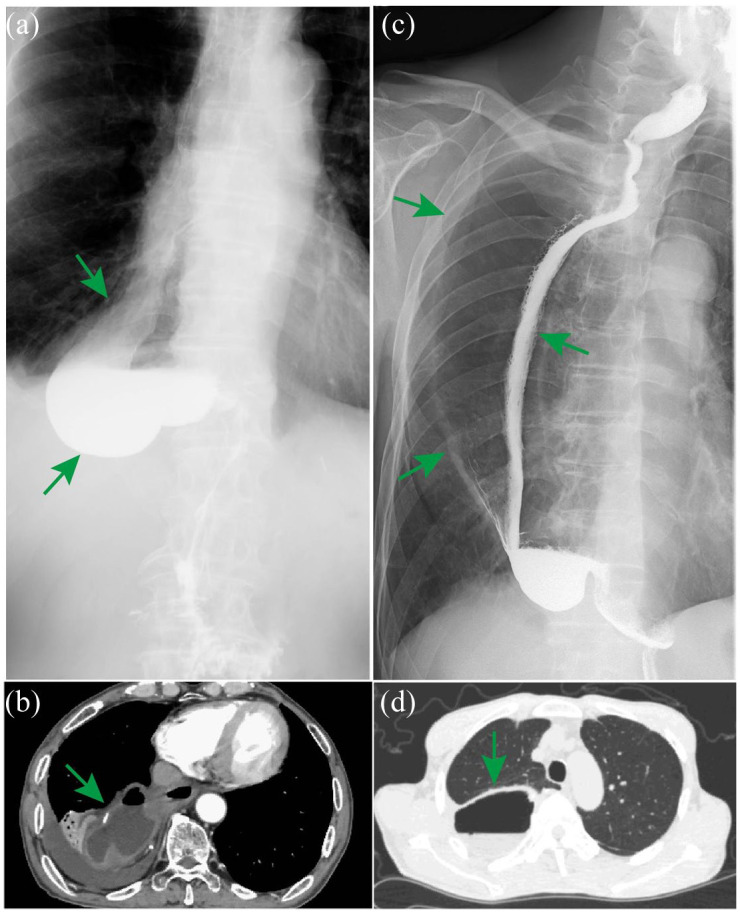 Rare complications after esophagectomy: incidence, clinical features, risk factors, management, and prevention.