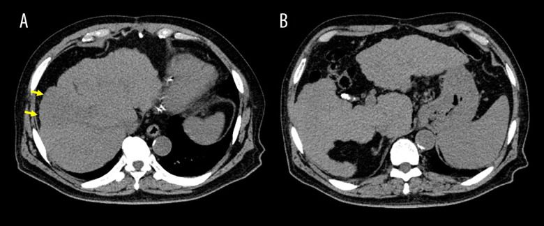 Rapid Progression of Primary Hepatic Neuroendocrine Carcinoma: A Case Report Demonstrating Drastic Oncological Behavior.