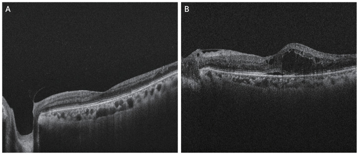 Macular Edema in Diabetic Neovascular Glaucoma and Its Association with Systemic Diseases.