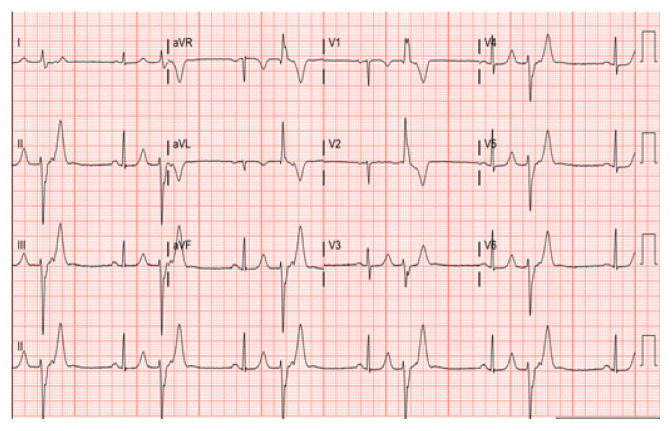 Premature Ventricular Contractions as an Underrecognized Cause of Chronic Cough: A Case of Misdiagnosis in a Patient with Bronchiectasis.