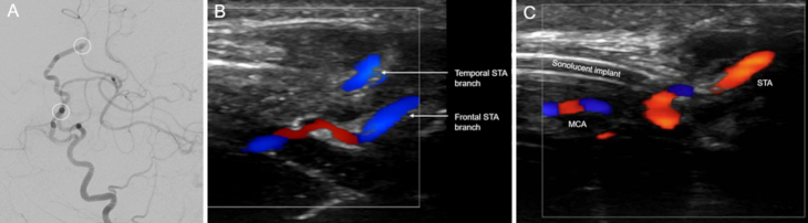 Cranial bypass for occlusive carotid dissection in osteogenesis imperfecta: illustrative case.