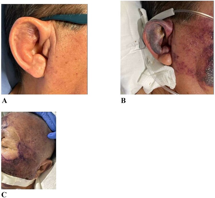 Fatal facial necrotizing fasciitis: a case report highlighting diagnostic and therapeutic challenges.