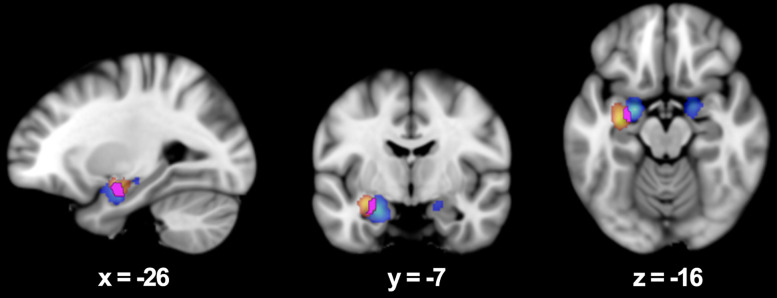 [Study of Successful Emotional Memory Encoding with Functional Magnetic Resonance Imaging: A Meta-Analysis Comparing the Affective Salience of Words Versus Images].