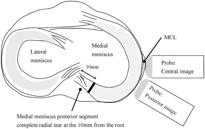 Inside-Out Repair Technique Results in Less Medial Meniscal Extrusion Than All-Inside Repair Technique for Complete Radial Tears of the Medial Meniscus Posterior Segment: A Cadaveric Study.