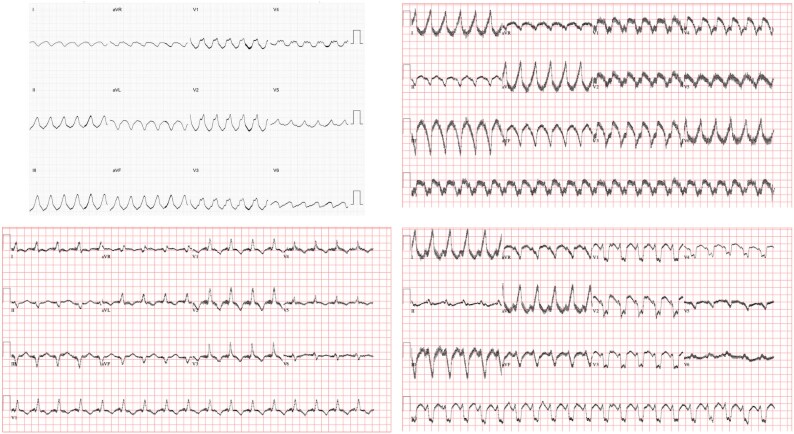 Sympathectomy in refractory ventricular arrhythmias in patients with left ventricular assist device: a grand round case report.