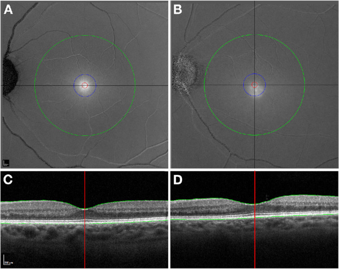 Advanced Analysis Tools for Two Wavelength Autofluorescence Imaging of Macular Xanthophyll Carotenoids: ALSTAR2 Baseline.