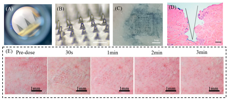 Enhanced Transdermal Delivery of Lidocaine Hydrochloride via Dissolvable Microneedles (LH-DMNs) for Rapid Local Anesthesia.