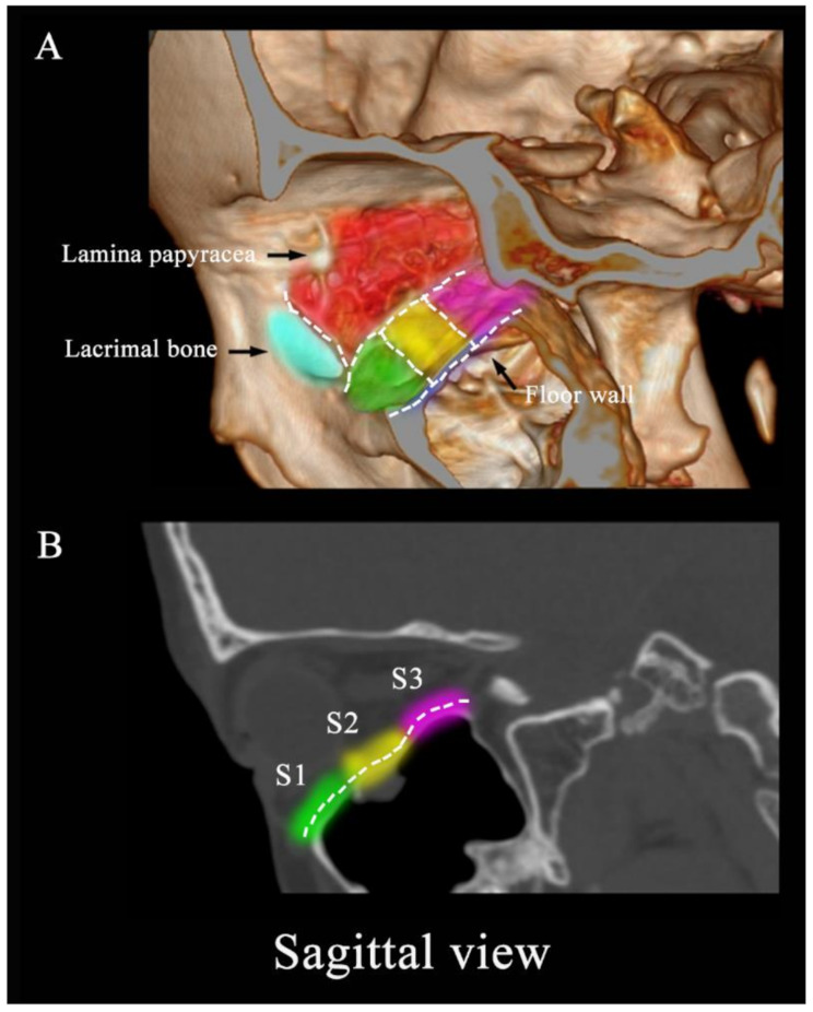Predictors of diplopia following orbital fractures based on anatomical location, a retrospective cohort study.